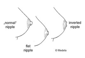 grafic normal, flat and inverted nipple